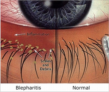 Blepharitis Diagram