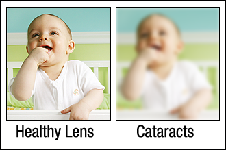 Vision with cataracts