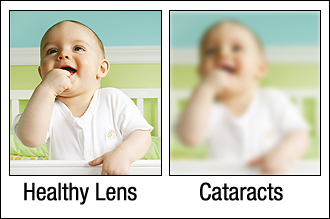 Vision with Cataracts