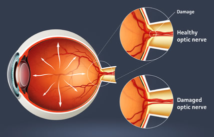 What Causes Glaucoma?