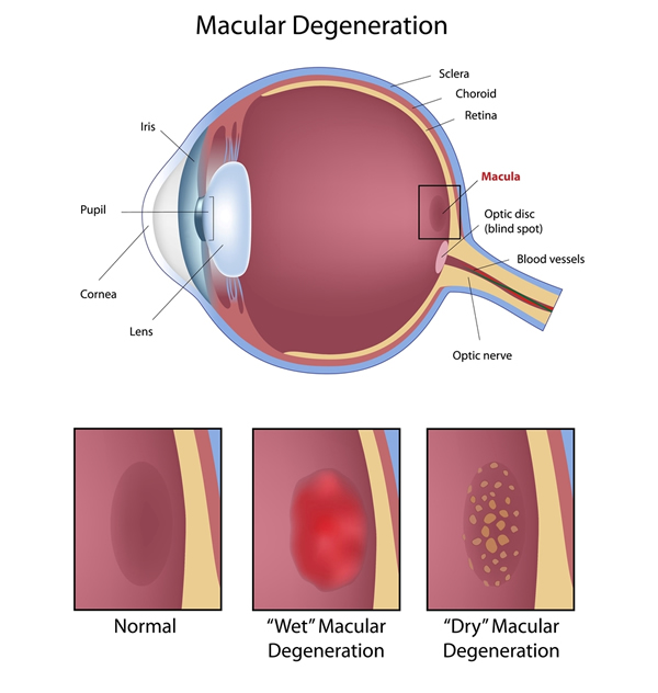 Macular Degeneration Diagram