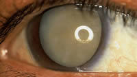 Mature Cataracts