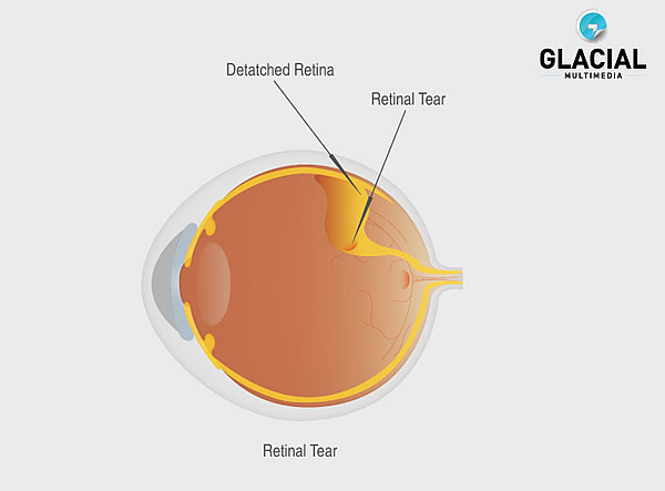 Retinal Tear Example