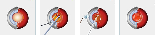 Cataract Surgery Diagram